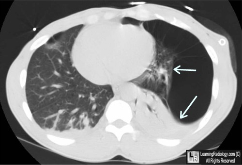 vanishing lung syndrome